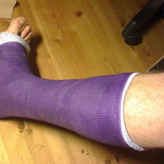 leg in cast